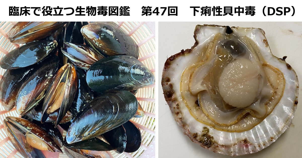 第47回　下痢性貝中毒（DSP）上條 吉人（埼玉医科大学特任教授・臨床中毒学講座 / 同大学病院臨床中毒センター長）